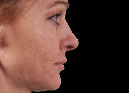 Exilis_Ultra_360_PIC_109-Before-face-neck-female-BTL-Aesthetics_412x296px