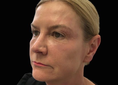 После 5 процедур EXILIS