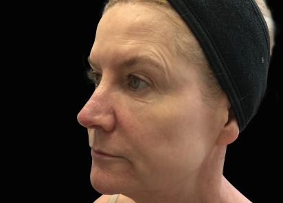 До процедур EXILIS