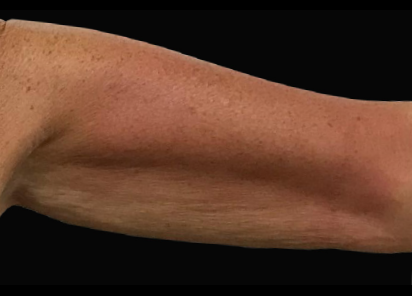 После 4 процедур EXILIS