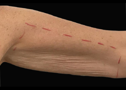 До процедур EXILIS