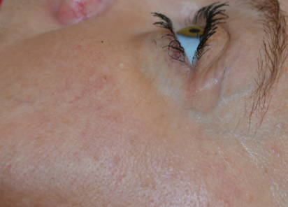 После 4 процедур EXILIS