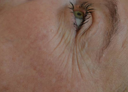 До процедур EXILIS