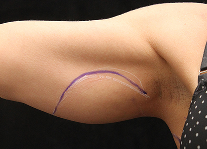 До процедур EXILIS