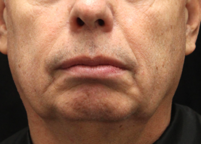 До процедур EXILIS