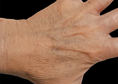 Exion_PIC_088-After-hands-female-BTL-Aesthetics-1M