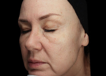 Exion_PIC_091-After-face-female-BTL-Aesthetics-1M_412x296px