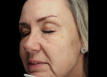 Exion_PIC_091-Before-face-female-BTL-Aesthetics_412x296px