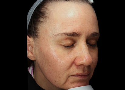 Exion_PIC_093-After-face-female-BTL-Aesthetics-1M_412x296px