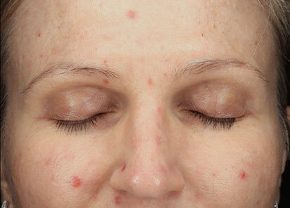 Exion_PIC_094-Before-face-female-BTL_412x296px