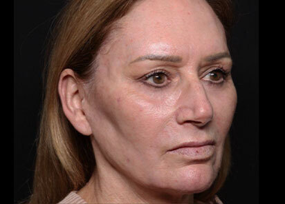 Exion_PIC_095-After-face-female-Diane-Duncan-MD-1M-1TX_412x296px