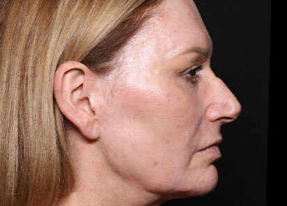 Exion_PIC_096-After-face-female-Diane-Duncan-MD-1M-1TX_412x296px