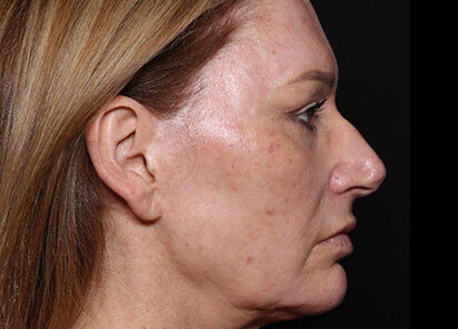 Exion_PIC_096-Before-face-female-Diane-Duncan-MD_412x296px