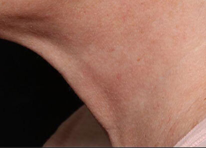 Exion_PIC_097-After-neck-female-Diane-Duncan-MD-1M-1TX_412x296px