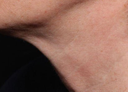 Exion_PIC_097-Before-neck-female-Diane-Duncan-MD_412x296px