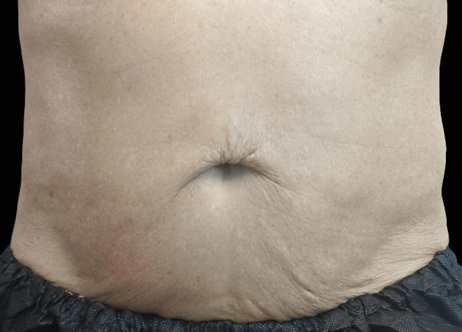 Exion_PIC_Ba-card-abdomen-male-019_Body_After_ENUS100