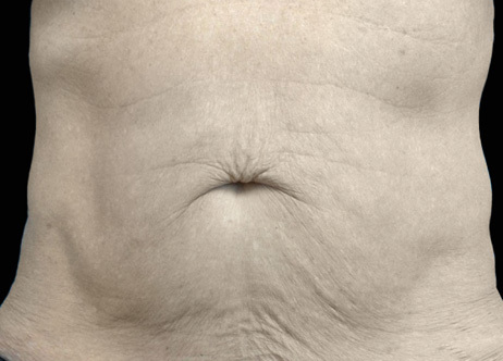 Exion_PIC_Ba-card-abdomen-male-019_Body_Before_ENUS100