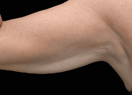 Exion_PIC_Ba-card-arms-female-042_Body_After_ENUS100