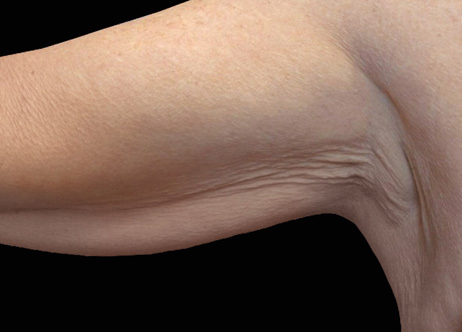 Exion_PIC_Ba-card-arms-female-042_Body_Before_ENUS100