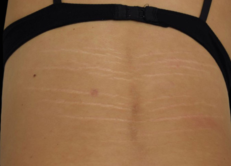 Exion_PIC_Ba-card-back-female-024_FRF_Before_ENUS100