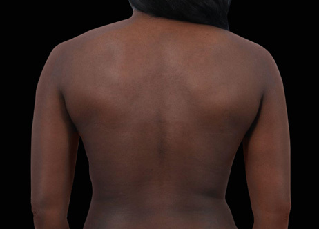 Exion_PIC_Ba-card-back-female-037_Body_After_ENUS100