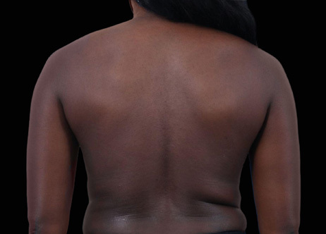 Exion_PIC_Ba-card-back-female-037_Body_Before_ENUS100