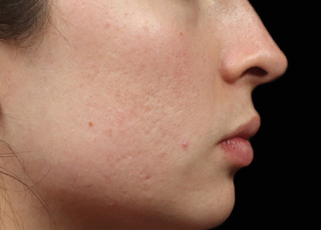 Exion_PIC_Ba-card-cheek-female-040_FRF_Before_ENUS100