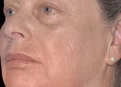 Exion_PIC_Ba-card-cheek-female-061_FRF_After_ENUS100