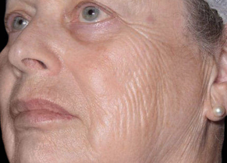 Exion_PIC_Ba-card-cheek-female-061_FRF_Before_ENUS100