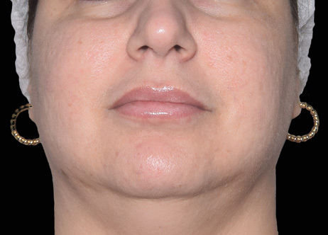 Exion_PIC_Ba-card-cheek-female-069_FRF_After_ENUS100