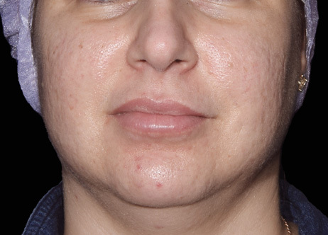 Exion_PIC_Ba-card-cheek-female-069_FRF_Before_ENUS100