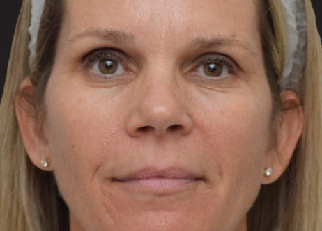 Exion_PIC_Ba-card-face-female-068_FRF_After_ENUS100