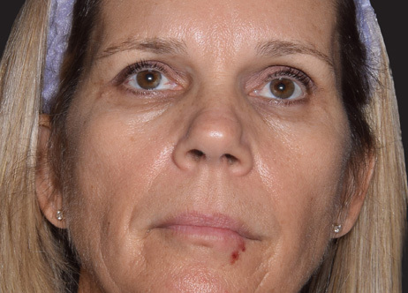 Exion_PIC_Ba-card-face-female-068_FRF_Before_ENUS100