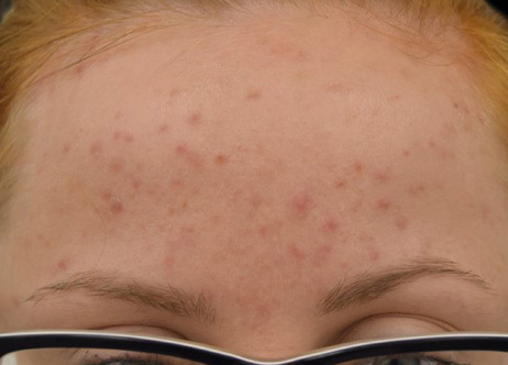 Exion_PIC_Ba-card-forehead-female-064_FRF_Before_ENUS100