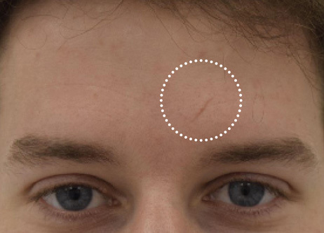 Exion_PIC_Ba-card-forehead-male-022_FRF_Before_ENUS100