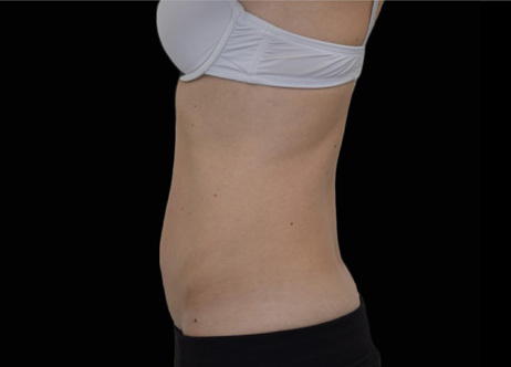 Exion_PIC_Ba-card-lateral_abdomen-female-034_Body_After_ENUS100