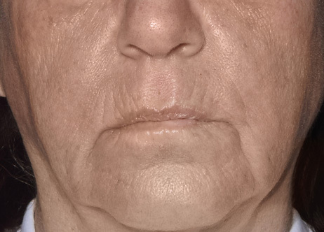 Exion_PIC_Ba-card-mouth-female-060_Face_Before_ENUS100