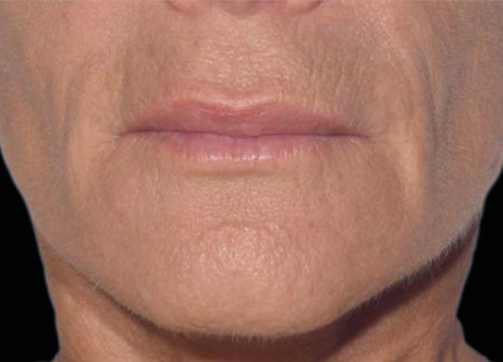 Exion_PIC_Ba-card-mouth-female-066_FRF_After_ENUS100