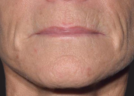 Exion_PIC_Ba-card-mouth-female-066_FRF_Before_ENUS100