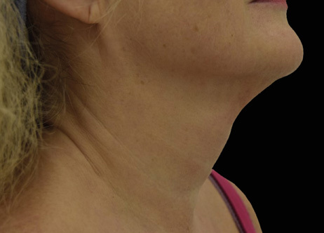 Exion_PIC_Ba-card-neck-female-063_FRF_Before_ENUS100