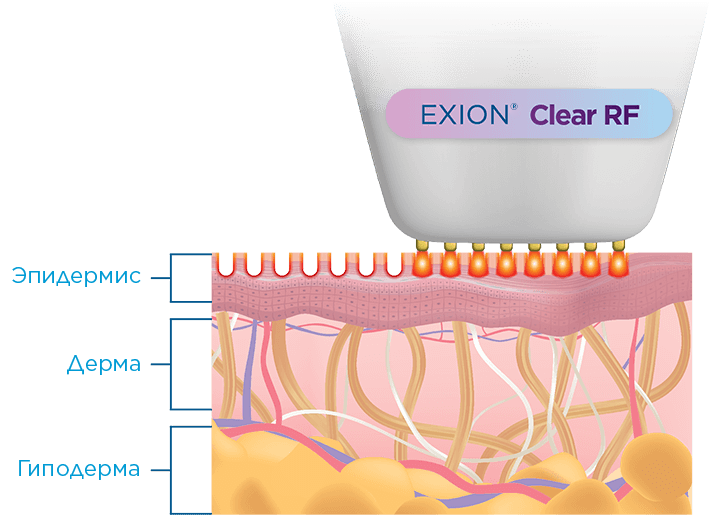 Exion_PIC_Moa-Clear-RF-EN100_1725976001_original