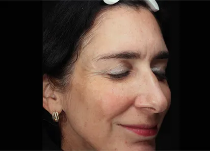 До процедуры на аппарате EMFUSION (фото 2)