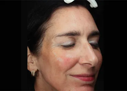 После процедуры на аппарате EMFUSION (фото 2)