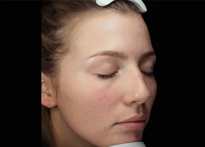 До процедуры на аппарате EMFUSION (фото 3)