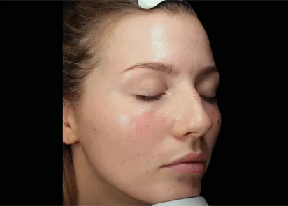 После процедуры на аппарате EMFUSION (фото 3)