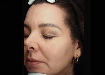 До процедуры на аппарате EMFUSION (фото 4)