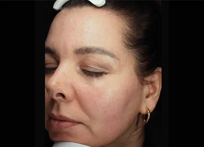 После процедуры на аппарате EMFUSION (фото 4)